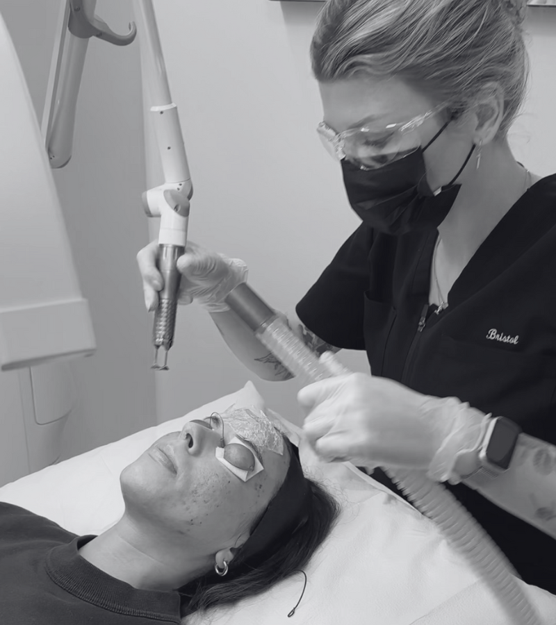 medical aesthetician performs laser resurfacing on acne prone skin